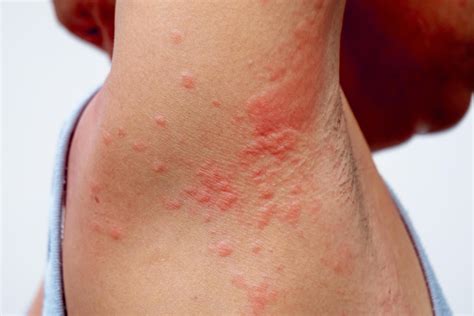 dermatitis alergica